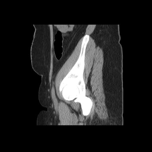 File:Bicornuate uterus- on MRI (Radiopaedia 49206-54296 A 20).jpg