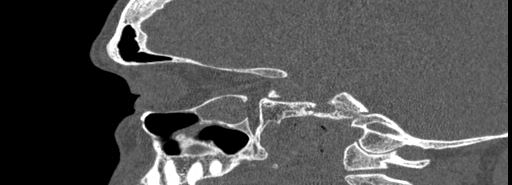 Bilateral Ectopic Infraorbital Nerves (Radiopaedia 49006-54084 Sagittal bone window 18).jpg