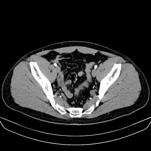 Bilateral accessory renal arteries with mild pelvi-ureteric junction (PUJ) obstruction (Radiopaedia 66357-75596 A 60).jpg