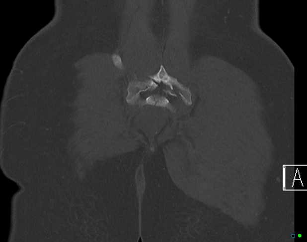 File:Bilateral acetabular fractures (Radiopaedia 79272-92308 Coronal bone window 41).jpg