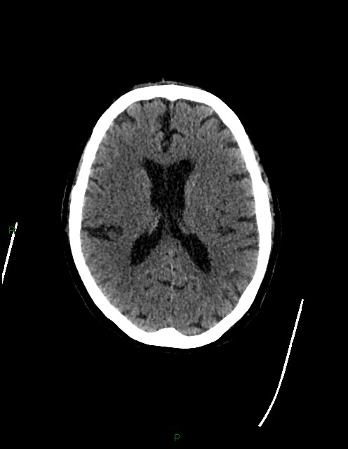 Bilateral acute middle cerebral artery territory infarcts (Radiopaedia 77319-89401 Axial non-contrast 51).jpg