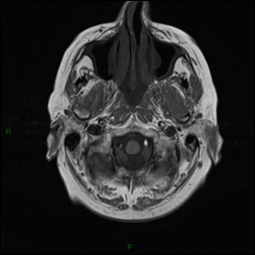 File:Bilateral acute middle cerebral artery territory infarcts (Radiopaedia 77319-89402 Axial T1 3).jpg