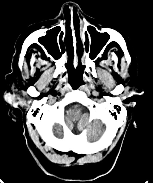 Bilateral acute on chronic subdural hematomas (Radiopaedia 78466-91146 Axial non-contrast 12).jpg
