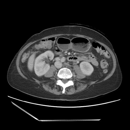 Bilateral adrenal granulocytic sarcomas (chloromas) (Radiopaedia 78375-91007 A 66).jpg