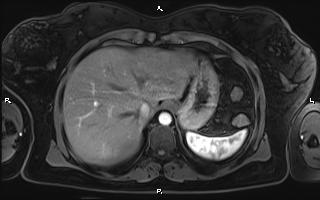 Bilateral adrenal myelolipoma (Radiopaedia 63058-71537 Axial T1 C+ fat sat 19).jpg