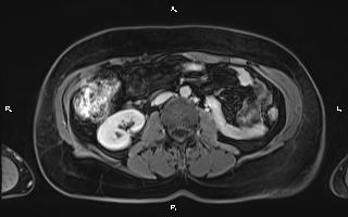 File:Bilateral adrenal myelolipoma (Radiopaedia 63058-71537 H 59).jpg