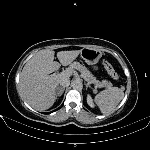 Bilateral benign adrenal adenomas (Radiopaedia 86912-103124 Axial C+ delayed 29).jpg