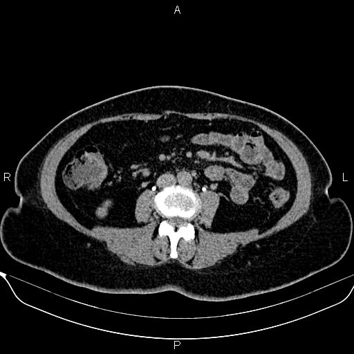 Bilateral benign adrenal adenomas (Radiopaedia 86912-103124 Axial C+ delayed 87).jpg