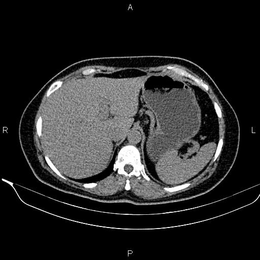 Bilateral benign adrenal adenomas (Radiopaedia 86912-103124 Axial non-contrast 28).jpg
