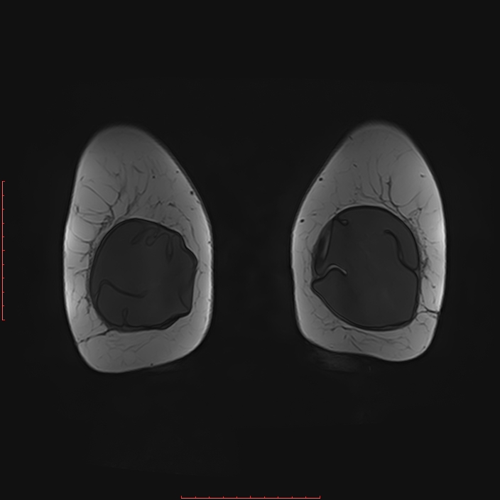 Bilateral breast implant rupture (Radiopaedia 24761-25027 G 87).jpg