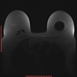 File:Bilateral breast implant rupture (Radiopaedia 24761-25027 PASTA 7).jpg