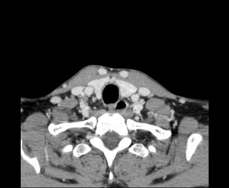 Bilateral carotid body tumors (Radiopaedia 61841-69870 Axial Post contrast 99).jpg