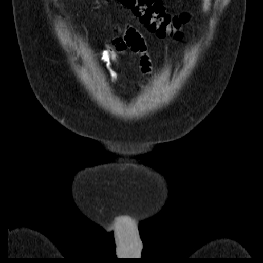 File:Bilateral direct inguinal herniae (Radiopaedia 17016-16719 A 1).jpg