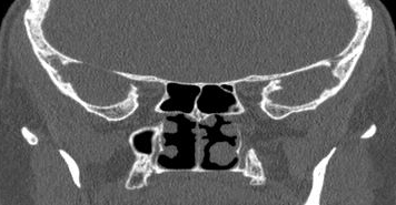 File:Bilateral ectopic infraorbital nerves (Radiopaedia 49006-54084 Coronal 6).png