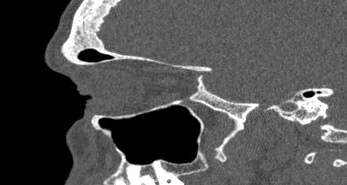 File:Bilateral ectopic infraorbital nerves (Radiopaedia 49006-54084 Sagittal 28).png
