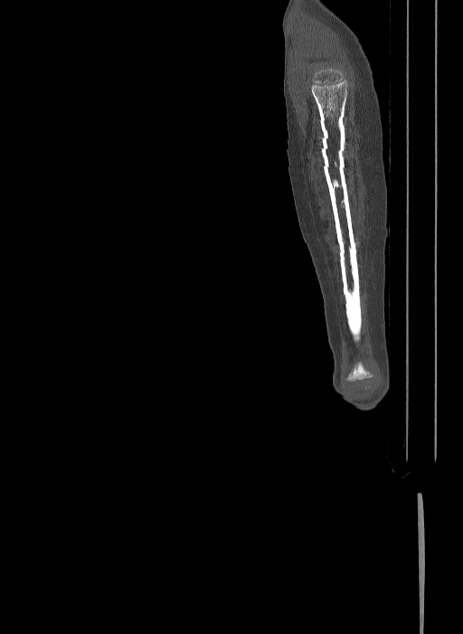 Bilateral fibular hemimelia type II (Radiopaedia 69581-79491 Sagittal bone window 72).jpg