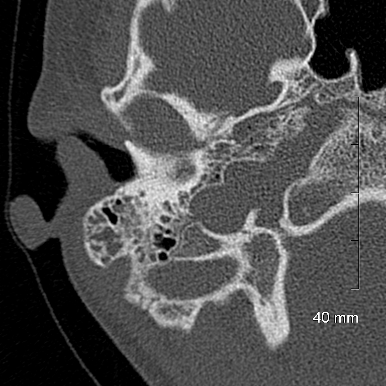 Bilateral grommets (Radiopaedia 47710-52404 Axial bone window 20).jpg