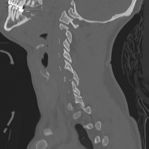 Bilateral locked facets (Radiopaedia 33850-35016 Sagittal bone window 10).png