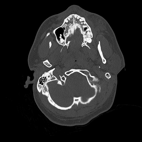 Bilateral occipital condyle fracture (type 2) (Radiopaedia 87675-104089 Axial bone thins 24).jpg