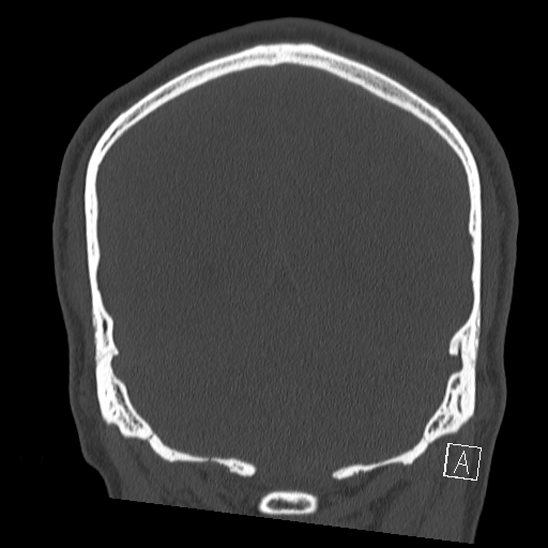 Bilateral occipital condyle fracture (type 2) (Radiopaedia 87675-104089 Coronal bone window 107).jpg