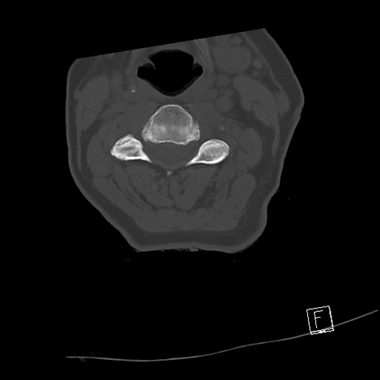 Bilateral occipital condyle fractures (type 3) (Radiopaedia 87672-104086 Axial bone window 36).jpg