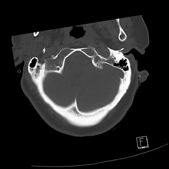 Bilateral occipital condyle fractures (type 3) (Radiopaedia 87672-104086 Axial bone window 8).jpg