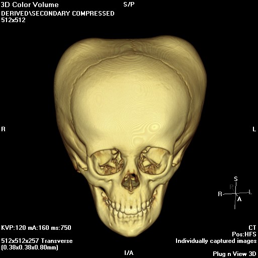 File:Bilateral ossified cephalohematomas (Radiopaedia 35830).jpg