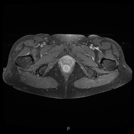 File:Bilateral ovarian fibroma (Radiopaedia 44568-48293 Axial T1 C+ fat sat 28).jpg