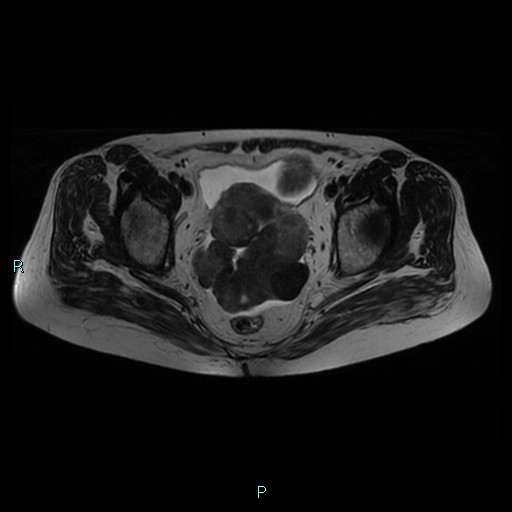 File:Bilateral ovarian fibroma (Radiopaedia 44568-48293 Axial T2 17).jpg