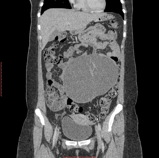 File:Bilateral ovarian serous cystadenocarcinoma with right ovarian torsion (Radiopaedia 32640-33611 B 12).jpg