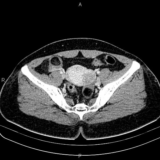 Bilateral ovarian teratoma (Radiopaedia 83131-97503 Axial With contrast 35).jpg