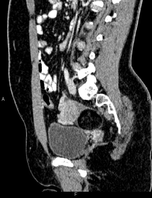 Bilateral ovarian teratoma (Radiopaedia 83131-97503 D 70).jpg