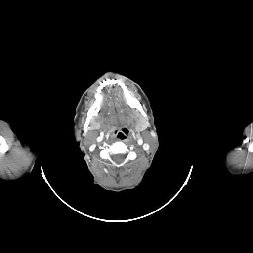 Bilateral parotid gland lymphoma (Radiopaedia 21038-20969 A 13).jpg