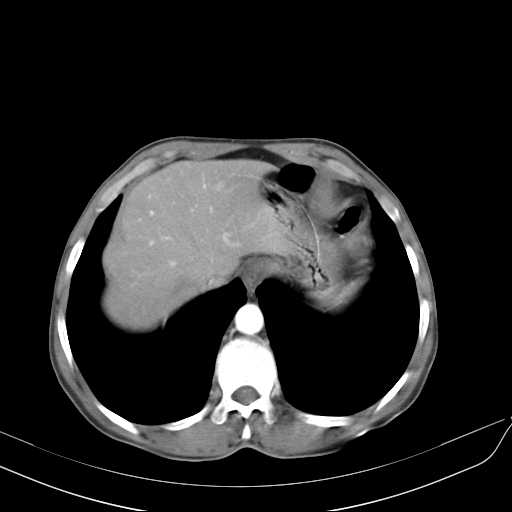 Bilateral parotid gland lymphoma (Radiopaedia 21038-20969 A 49).jpg