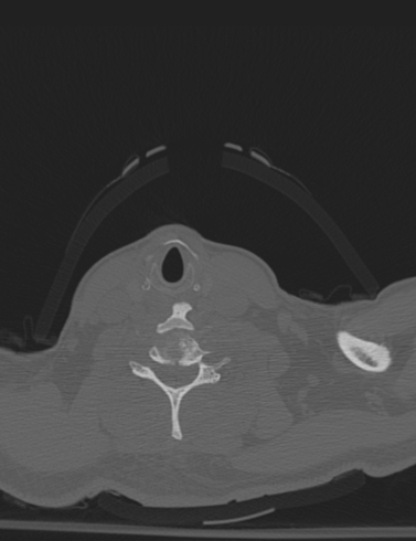 Bilateral perched facet joint (Radiopaedia 63149-71669 Axial bone window 49).jpg
