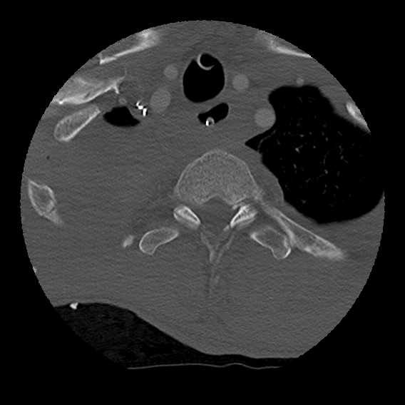 Bilateral perched facets with cord injury (Radiopaedia 45587-49713 Axial bone window 108).jpg