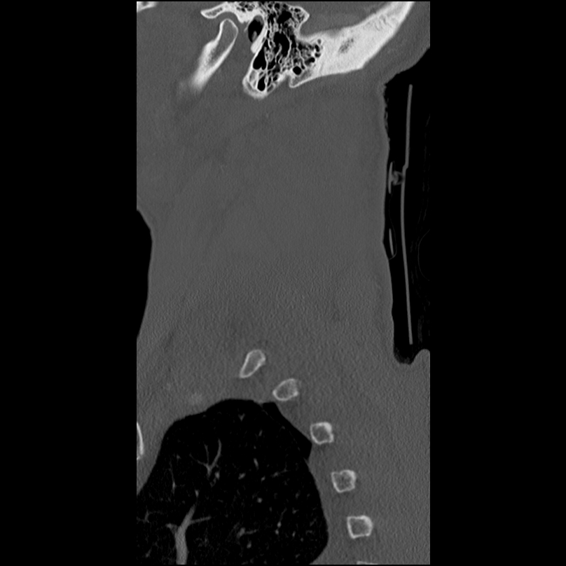 Bilateral perched facets with cord injury (Radiopaedia 45587-49713 Sagittal bone window 51).jpg
