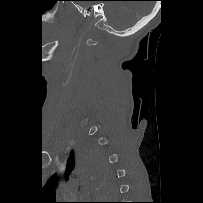 Bilateral perched facets with cord injury (Radiopaedia 45587-49713 Sagittal bone window 7).jpg
