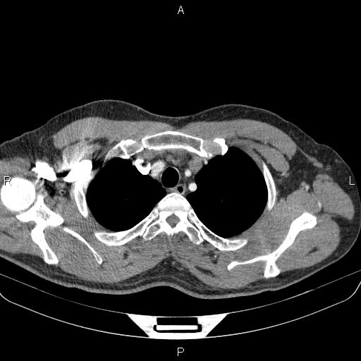 Bilateral pulmonary AVM (Radiopaedia 83134-97505 A 12).jpg