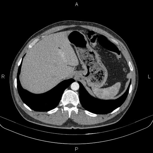 Bilateral pulmonary AVM (Radiopaedia 83134-97505 A 67).jpg