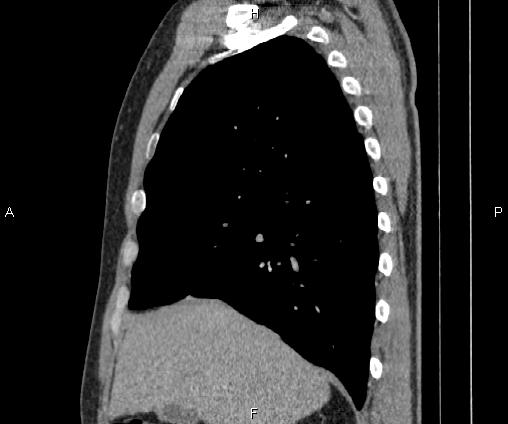 Bilateral pulmonary AVM (Radiopaedia 83134-97505 D 40).jpg