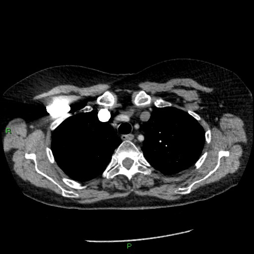 Bilateral pulmonary emboli (Radiopaedia 32700-33669 Axial C+ CTPA 21).jpg