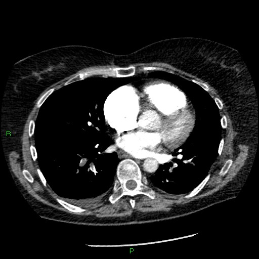Bilateral pulmonary emboli (Radiopaedia 32700-33669 Axial C+ CTPA 64).jpg