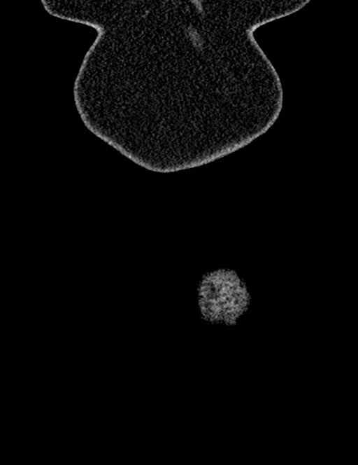 Bilateral staghorn calculi (Radiopaedia 59475-66842 Coronal non-contrast 24).jpg
