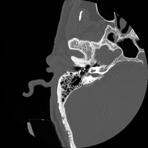 File:Bilateral temporal bone fractures (Radiopaedia 29482-29970 Axial non-contrast 26).jpg