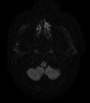 File:Bilateral thalamic glioma (Radiopaedia 65852-75009 Axial DWI 1).jpg