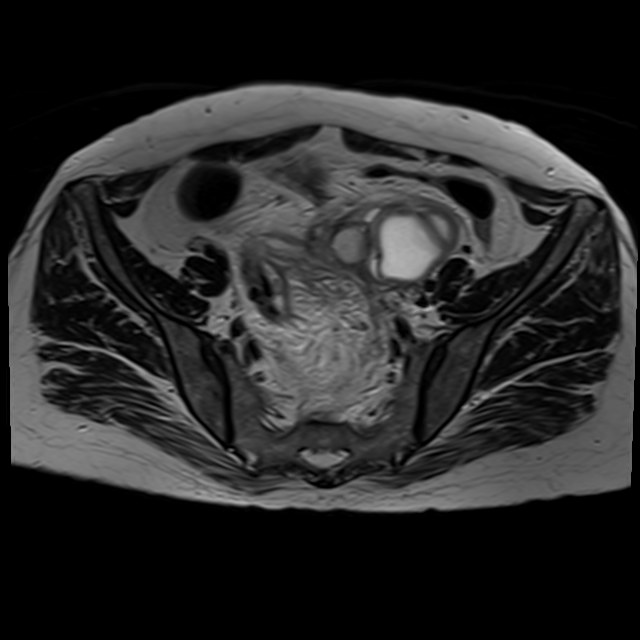 Bilateral tubo-ovarian abscesses (Radiopaedia 58635-65829 Axial T2 14).jpg