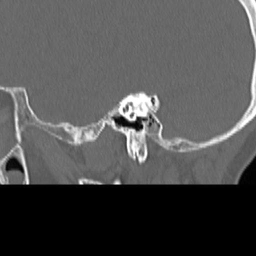 File:Bilateral tympanoplasty (Radiopaedia 16947-16664 Sagittal bone window 35).jpg