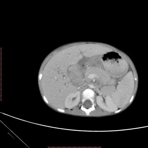 Biliary tract embryonal rhabdomyosarcoma (Radiopaedia 51815-57648 A 38).jpg