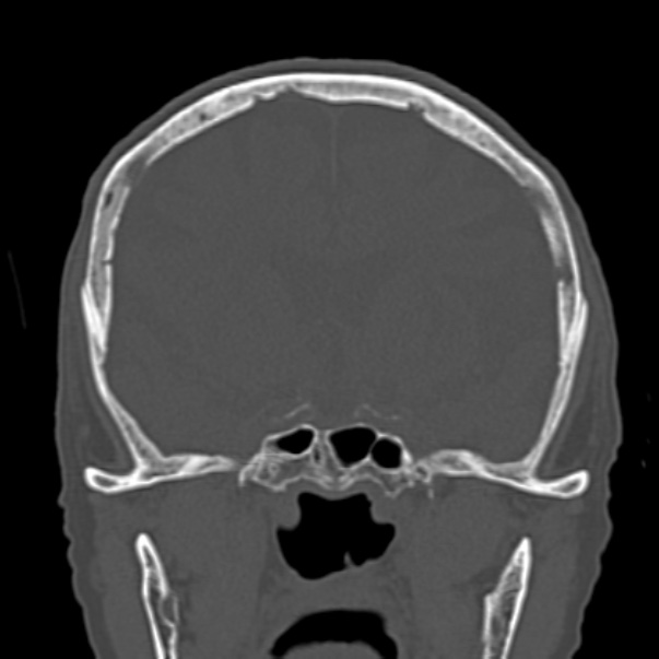 Biparietal osteodystrophy (Radiopaedia 46109-50463 Coronal bone window 47).jpg